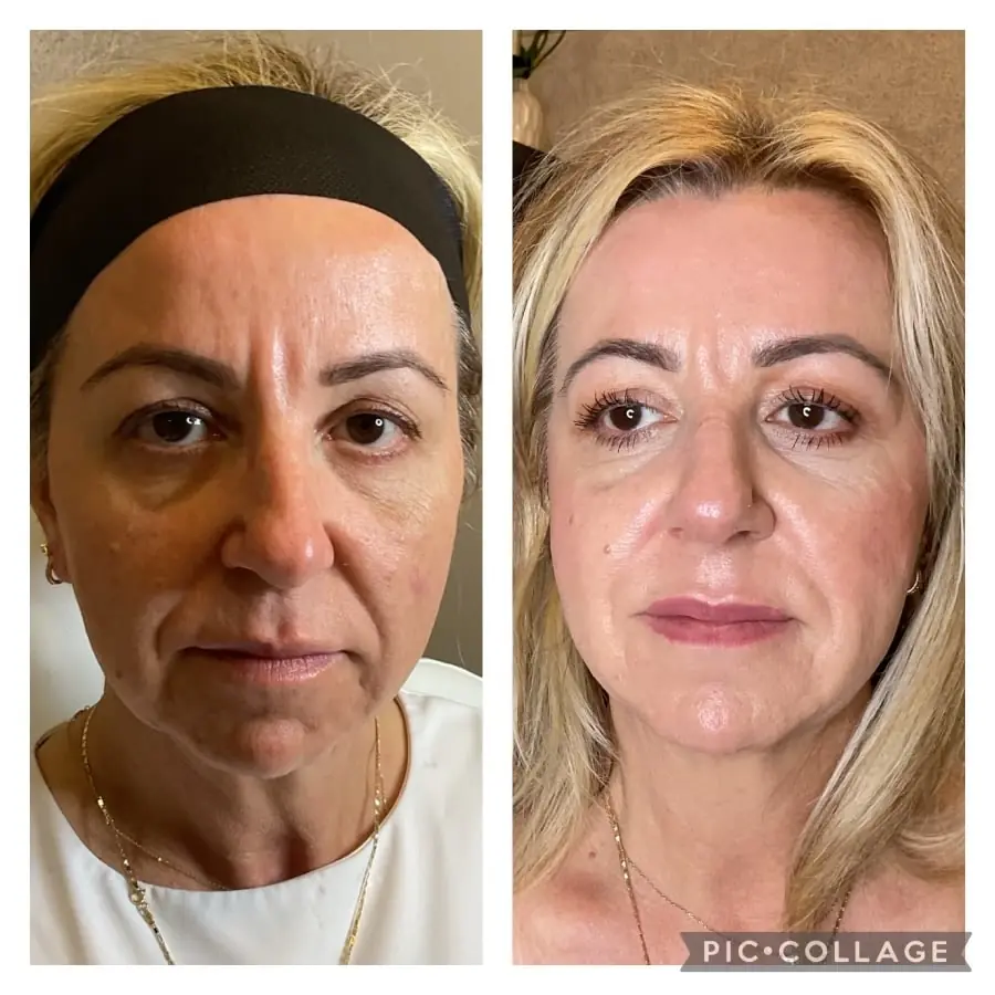 NFuze patient result, front view before and after treatment